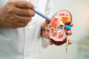 Vera Therapeutics Atacicept Shows Promising Results in Phase 2b ORIGIN Trial for IgA Nephropathy
